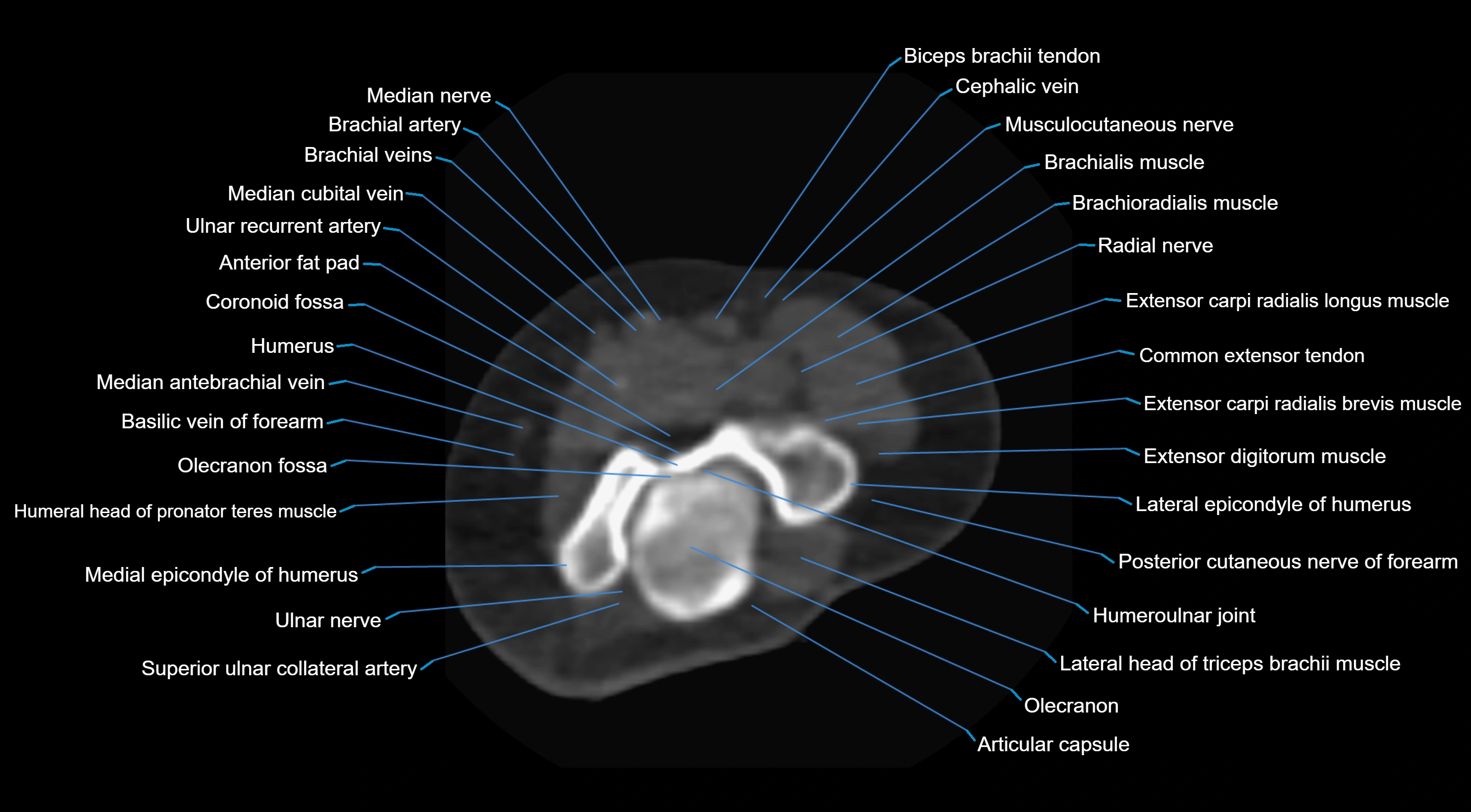 CT elbow axial  cross sectional anatomy labelled  radiology image -00017.webp